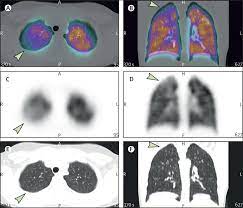 Evidence of lung-perfusion defects and ongoing inflammation in-an adolescent with post acute sequelae of SARS CoV-2 infection￼